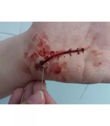 Herida Puntos ∣ Harpo