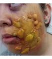 Herida ampolla Molde 4